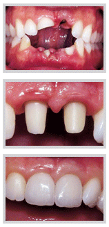 Bone graft preparing the ridge for dental implants, Lebanon