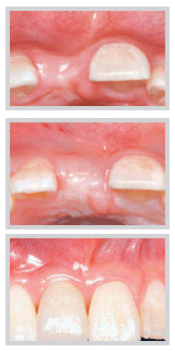 Guided bone regeneration with membrane, Smile Infinity Lebanon