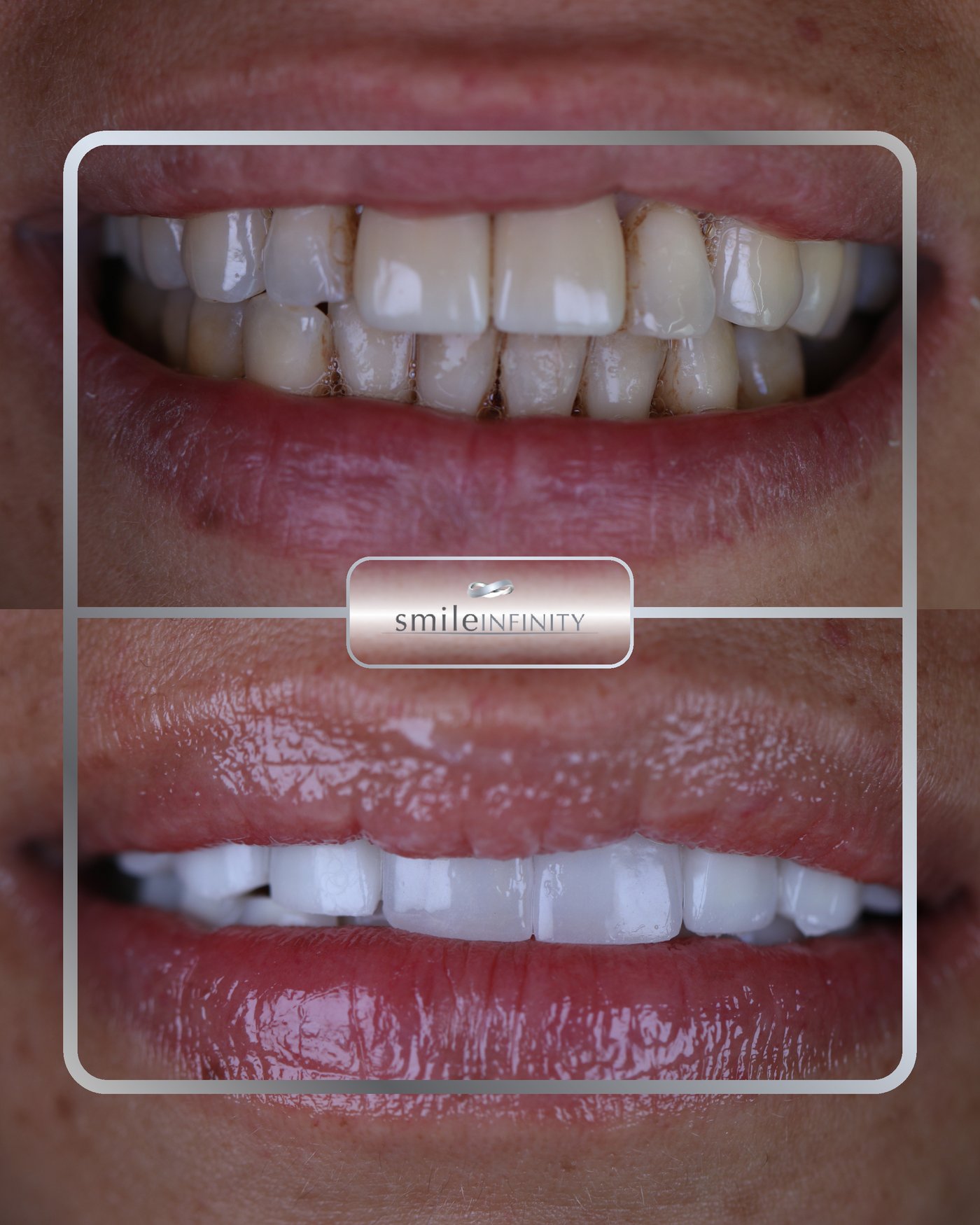 Composite veneers Ferrari Smile direct bonding by Dr. Habib Zarifeh, Beirut Lebanon
