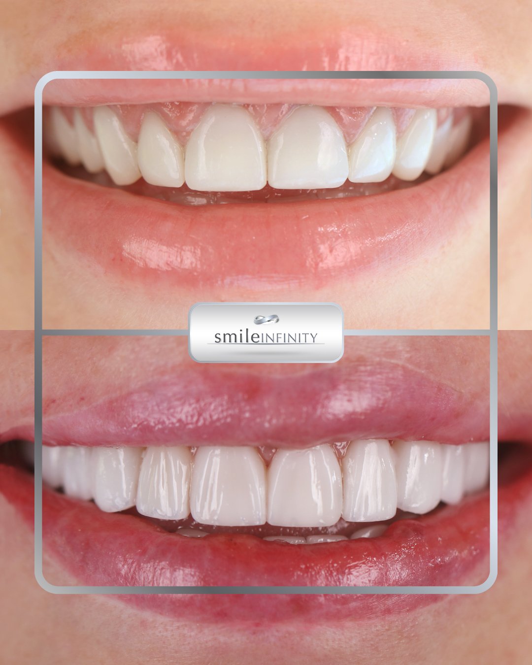 Composite veneers smile makeover result, Smile Infinity by Dr. Habib Zarifeh