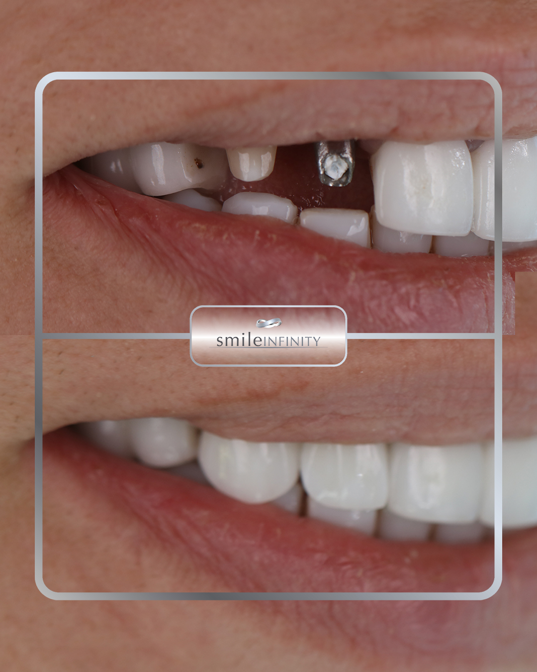 Full-mouth dental implant rehabilitation, Smile Infinity by Dr. Habib Zarifeh