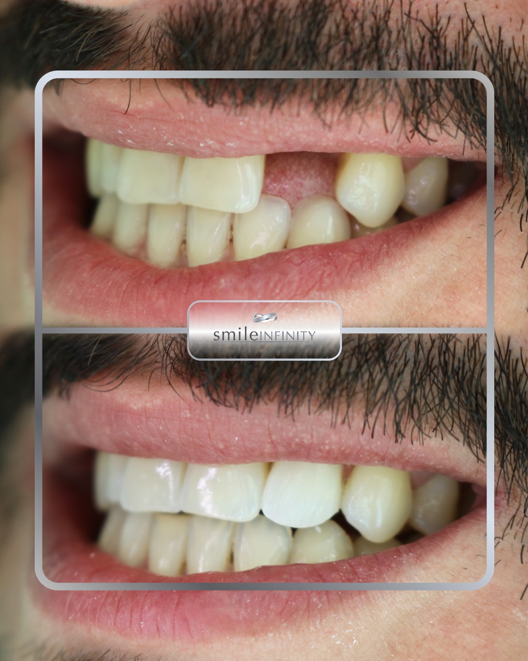 Guided dental implant surgery with CBCT planning, Beirut