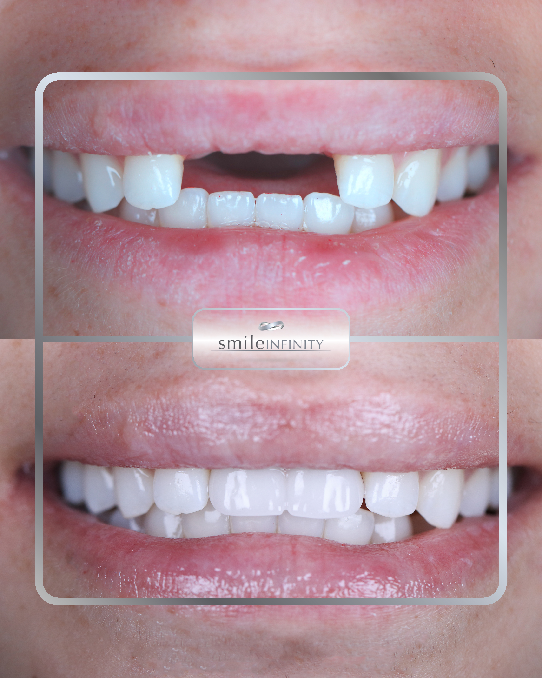 Dental implants combined with veneers Hollywood smile, Smile Infinity