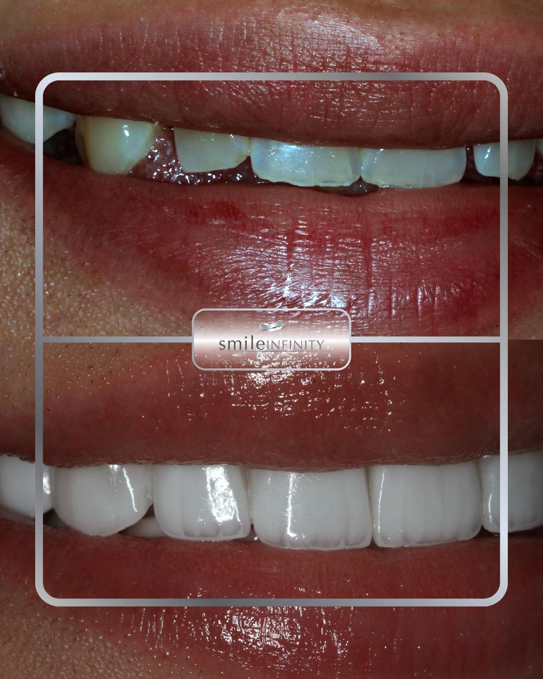 Hollywood smile designed on CAD/CAM and 3D printing, Smile Infinity lab