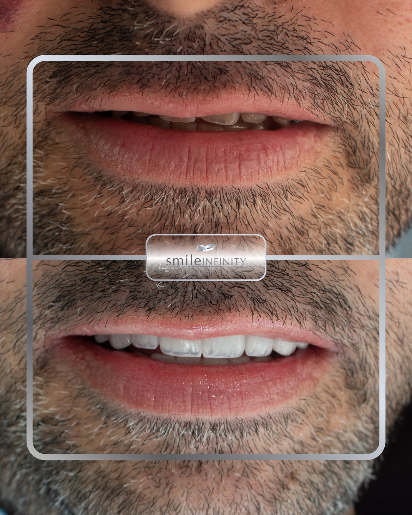 Full Hollywood smile result by Dr. Habib Zarifeh, Lebanon