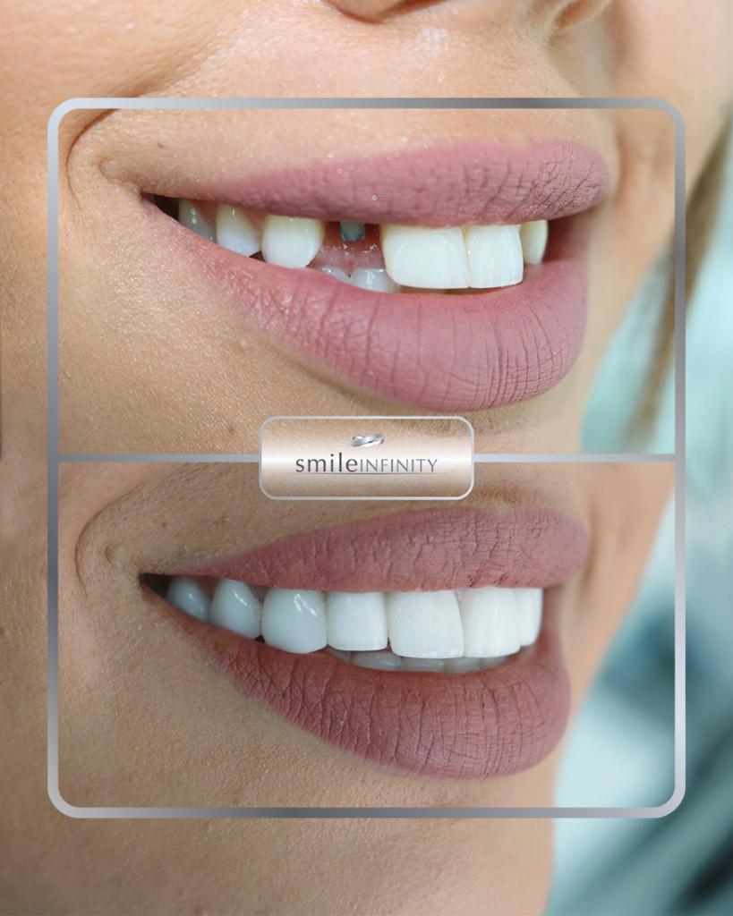 Hollywood smile with laser gummy smile correction, Smile Infinity Beirut