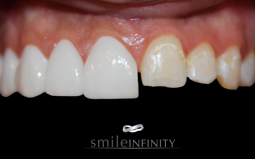 Hollywood smile with lip aesthetics, Smile Infinity plastic and dermatology