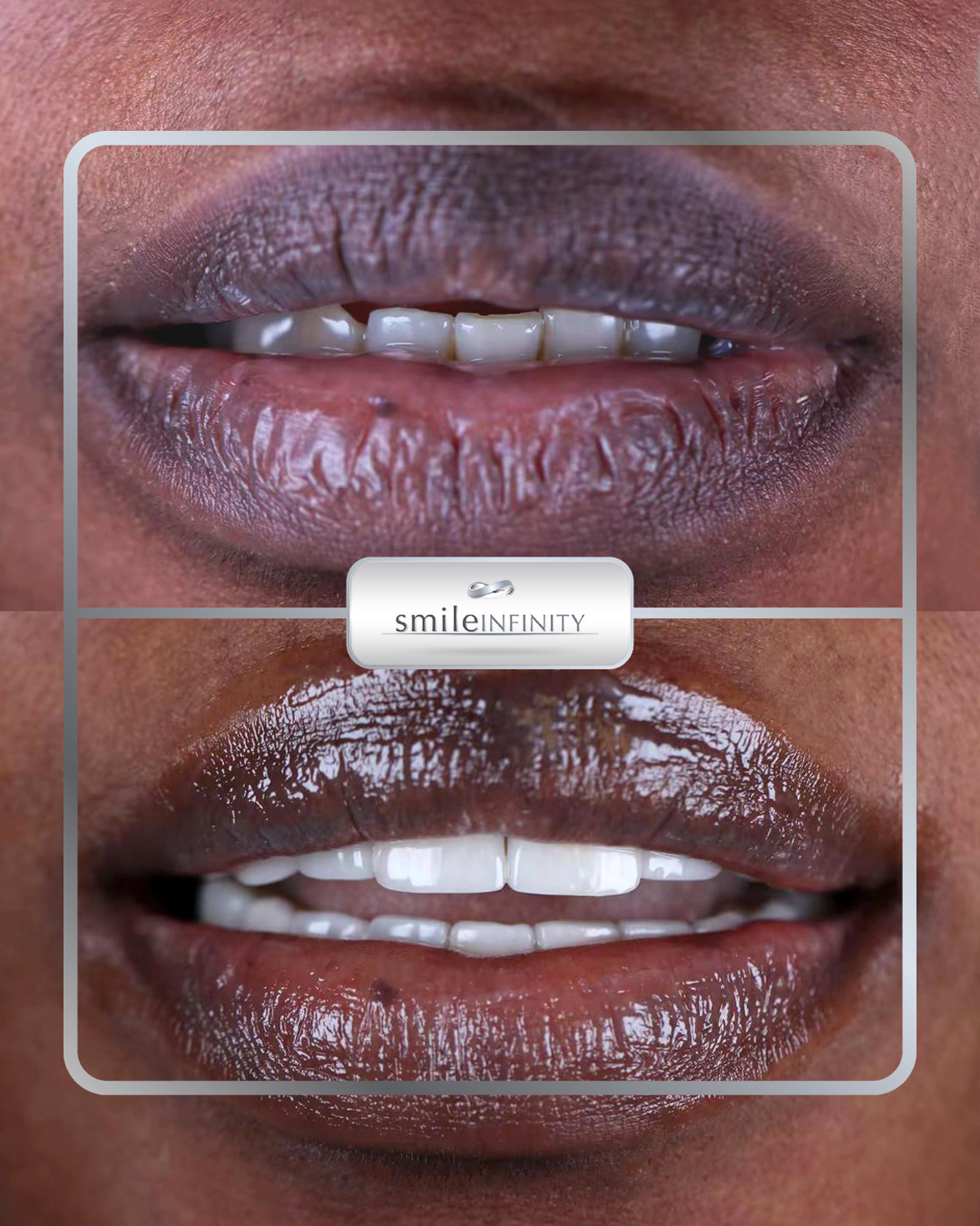 Hollywood smile with ZEvolution German-technology veneers, Smile Infinity