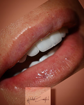 Lumineers before and after Hollywood smile, Lebanon