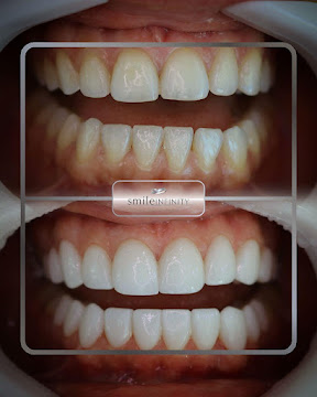 Lumineers bonding with no drilling, Smile Infinity Beirut