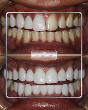 Cerinate ultra-thin Lumineers smile makeover at Smile Infinity Beirut