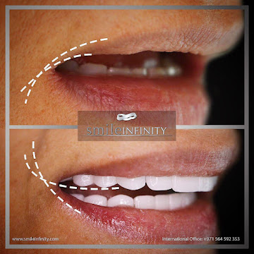 Lumineers diastema closure, Smile Infinity Beirut Lebanon