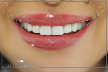 Full smile makeover with Lumineers and lip aesthetics, Smile Infinity