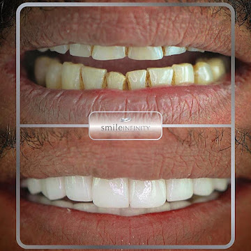 Lumineers combined with laser gummy smile correction, Beirut