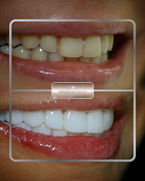 Natural Lumineers Hollywood smile result by Dr. Habib Zarifeh