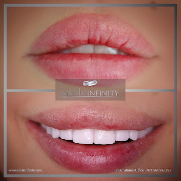 No-prep Lumineers Hollywood smile by Dr. Habib Zarifeh, Beirut Lebanon