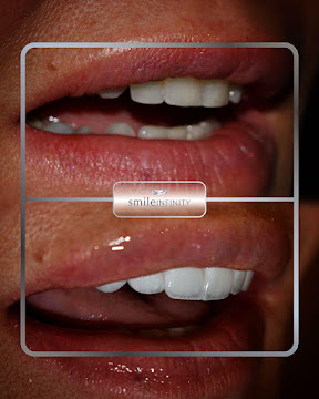 Lumineers placement with CAD/CAM precision, Smile Infinity lab