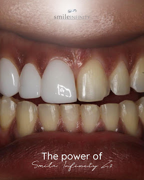 Lumineers correcting stained teeth, Dr. Habib Zarifeh Lebanon
