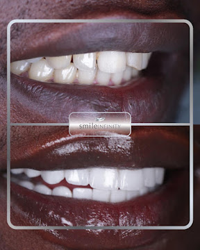 Ultra-thin 0.2 mm Lumineers veneers, Dr. Habib Zarifeh Lebanon