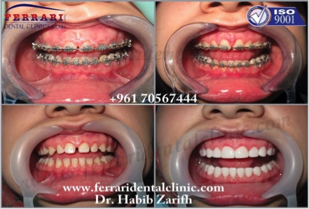orthodontic surgery by Dr. Habib Zarifeh