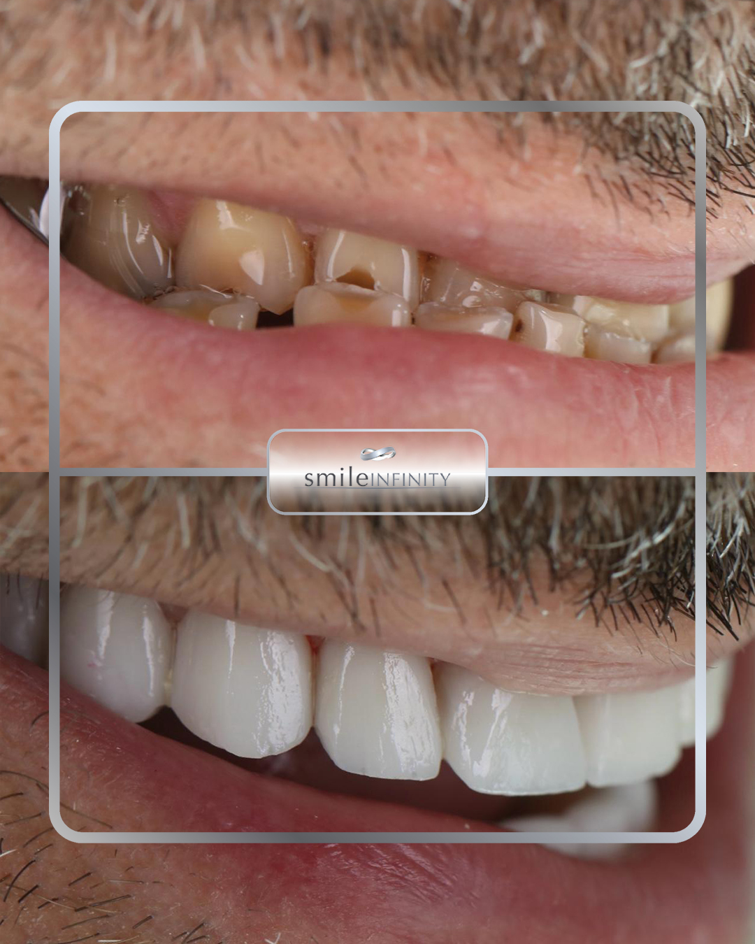 E.max non-prep porcelain veneers Hollywood smile by Dr. Habib Zarifeh, Beirut