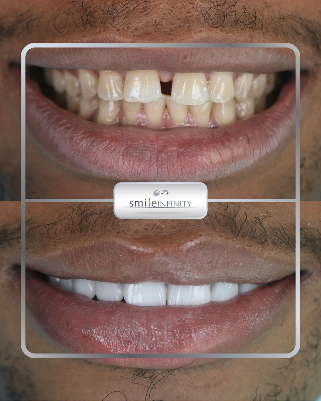 Full smile makeover with veneers and lip aesthetics, Smile Infinity