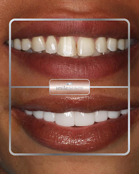 ZEvolution German-technology veneers, Smile Infinity Beirut Lebanon