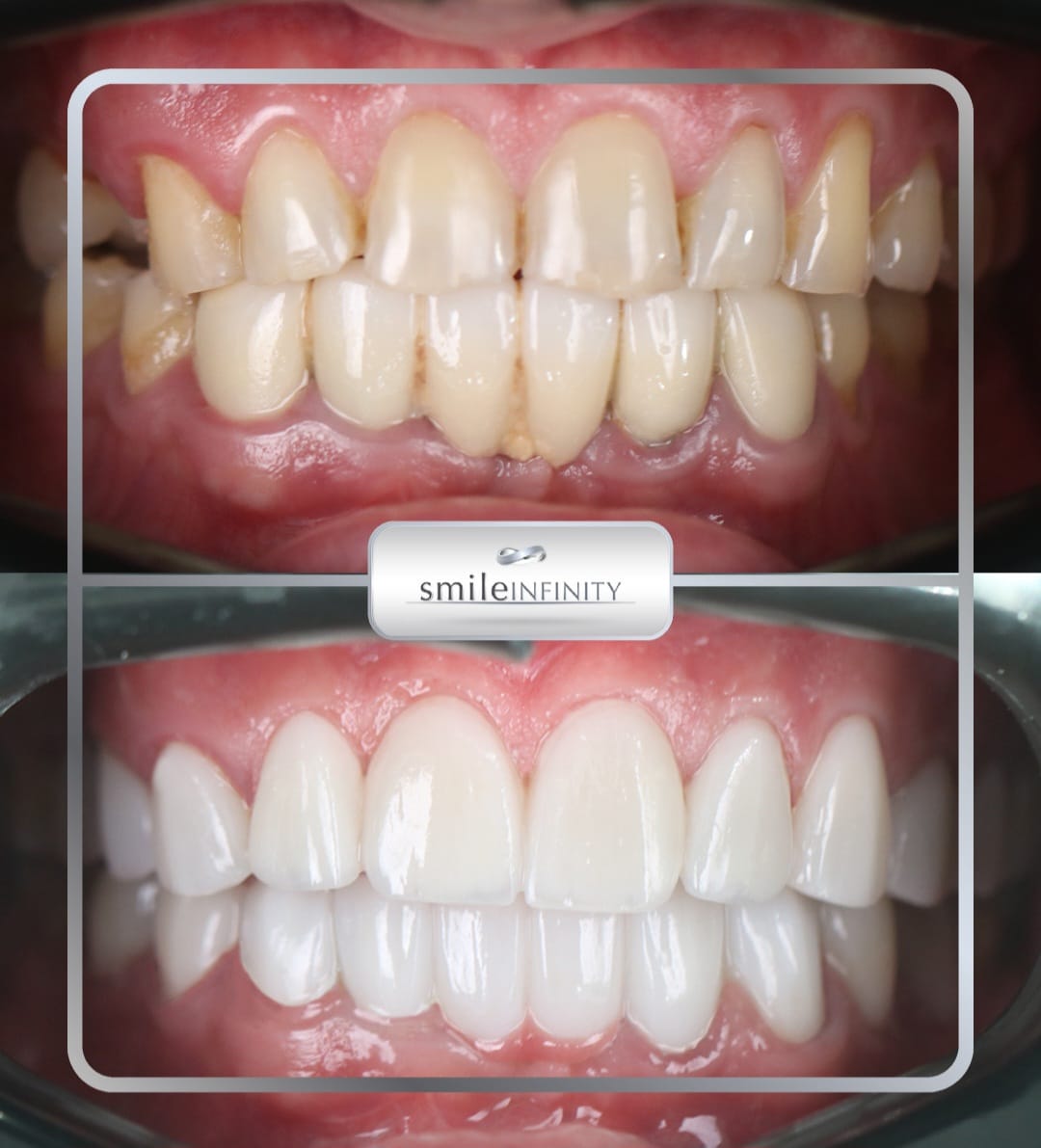 Zirconium crown milled by CAD/CAM, Smile Infinity Beirut by Dr. Habib Zarifeh
