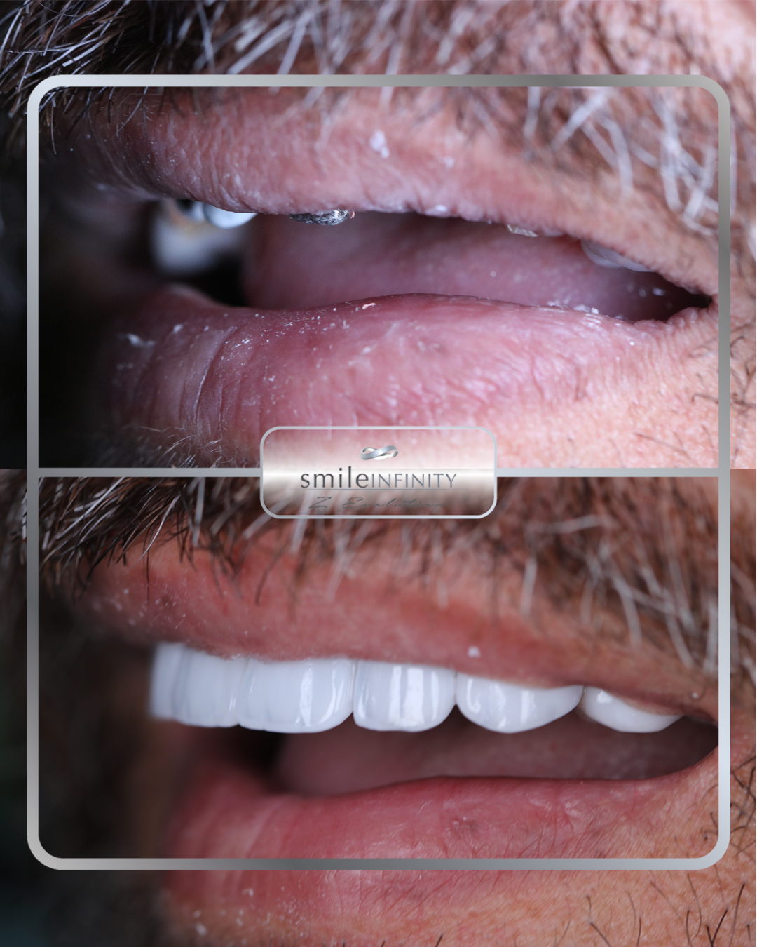 Full-arch zirconium crowns, Smile Infinity Lebanon