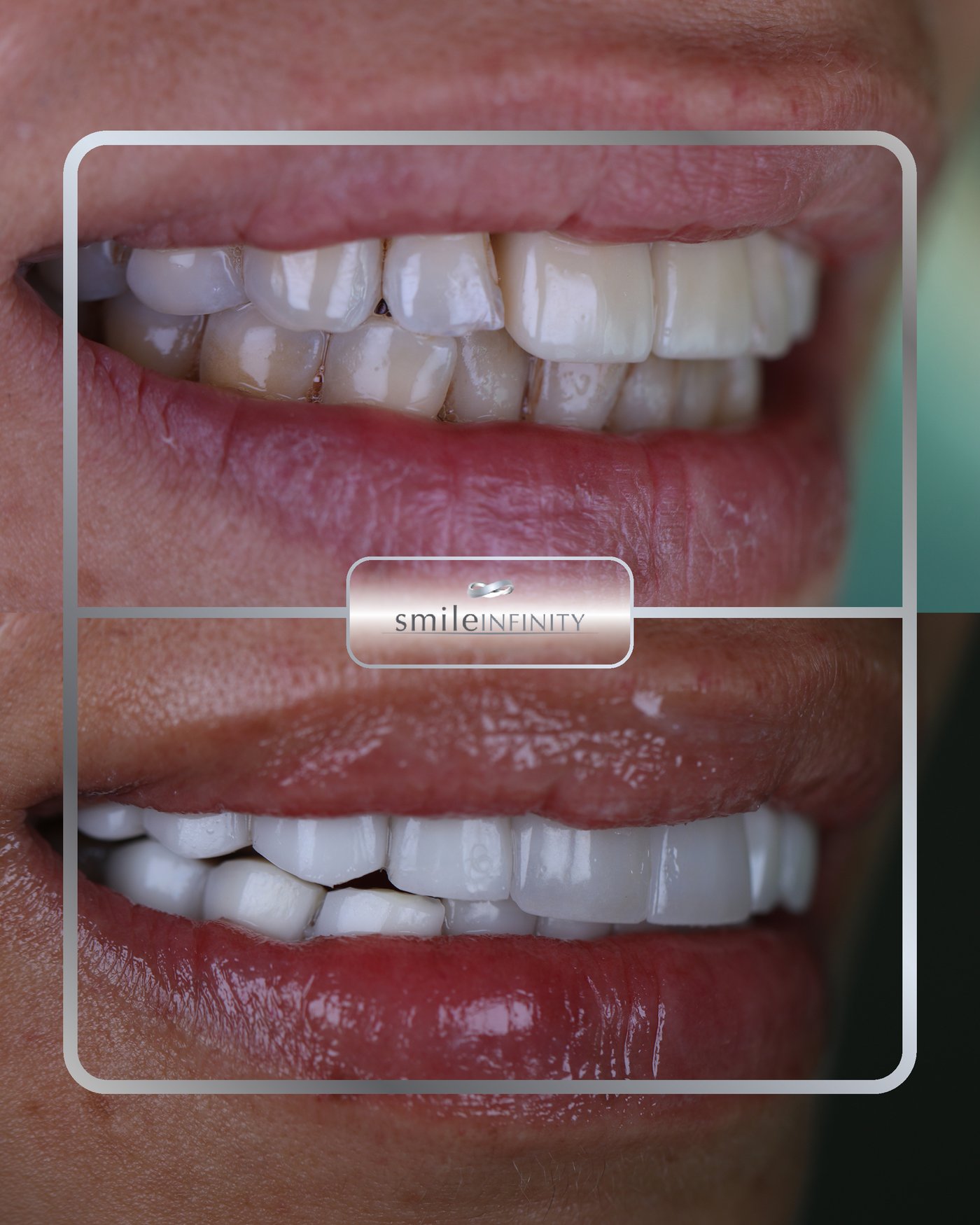 Zirconium crown Hollywood smile makeover, Smile Infinity Beirut
