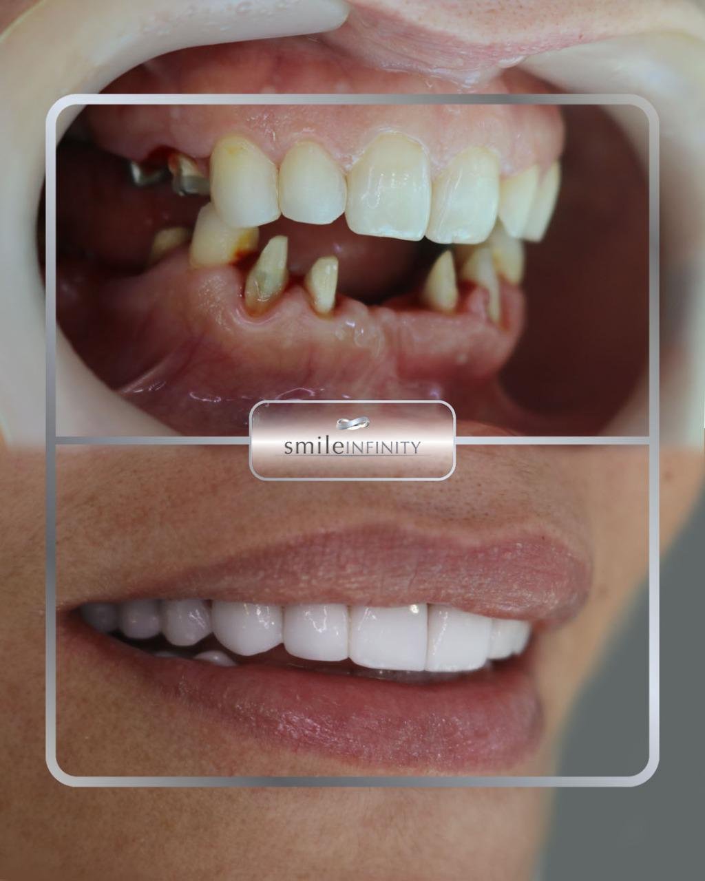 Natural zirconium crown result, Smile Infinity Lebanon