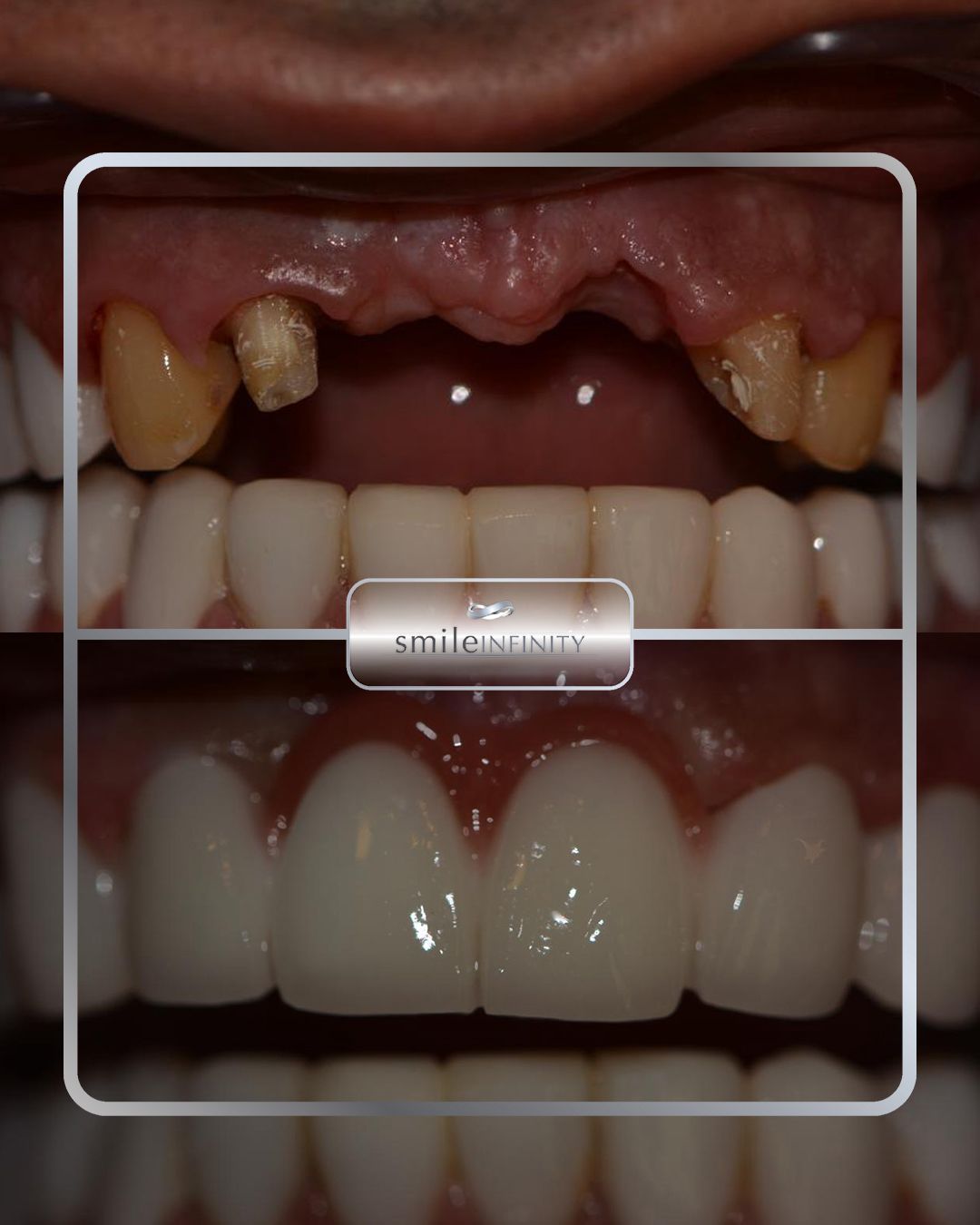 Zirconium crown bonded with Variolink by Ivoclar, Dr. Habib Zarifeh Beirut